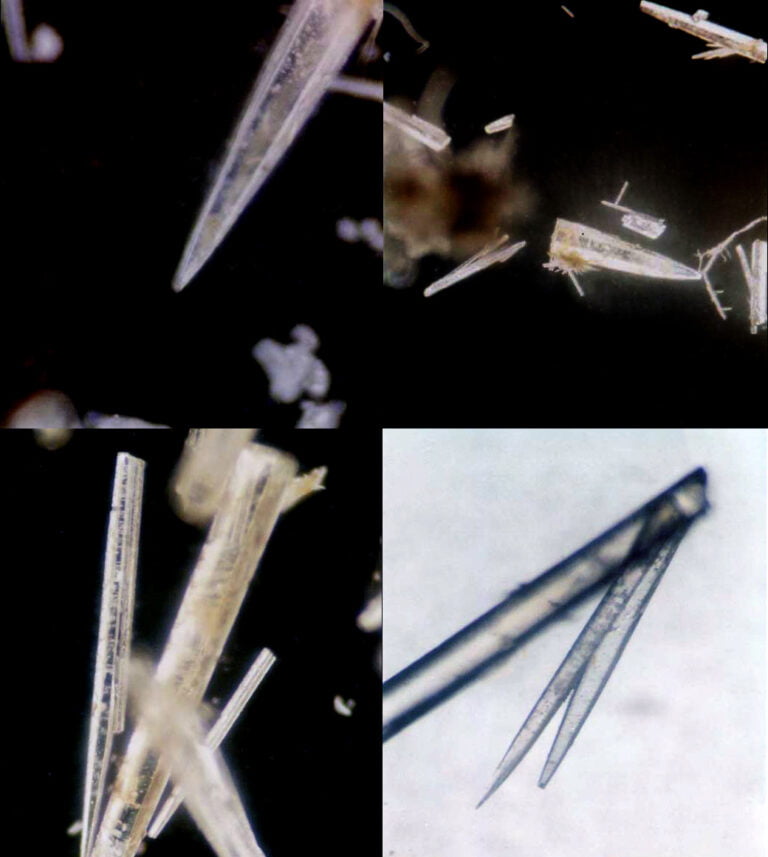 Kalkkristallbilder nach UV-Sterilisation des Wassers ohne UMH-Behandlung